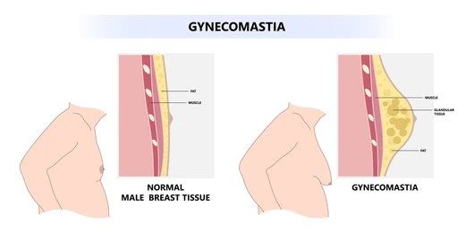 anavar cause gyno