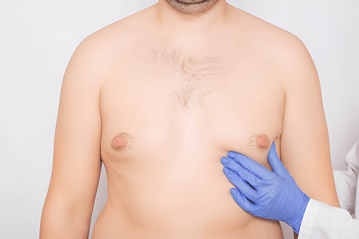 gynecomastia pinch test