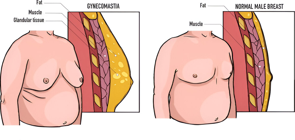 what is the pinch test for gynecomastia?
