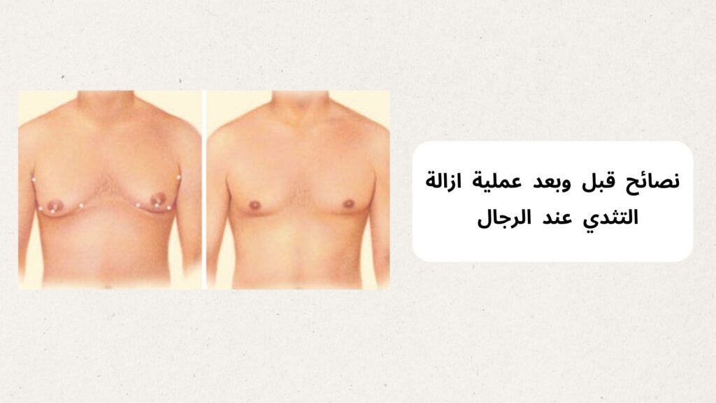 عملية ازالة التثدي عند الرجال