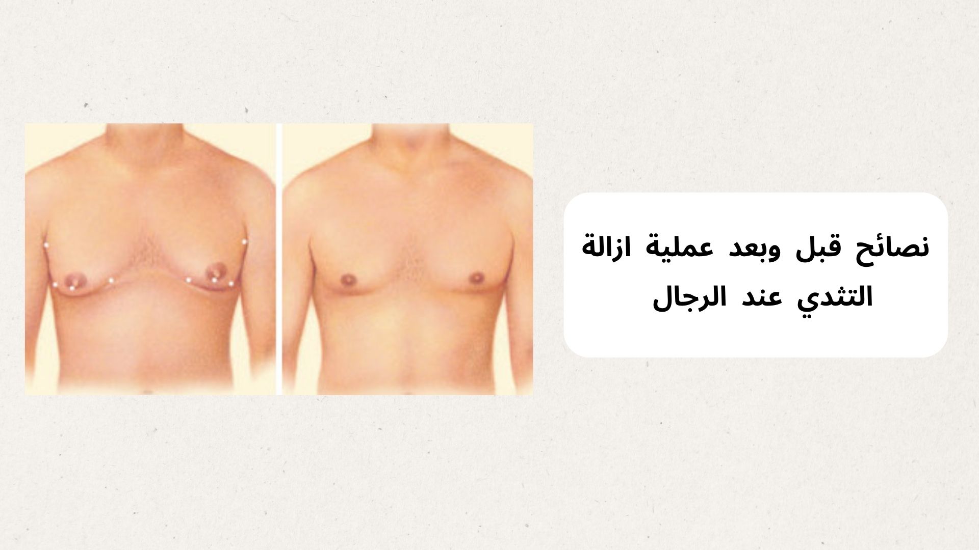 عملية ازالة التثدي عند الرجال